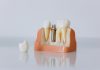 Cât costă un implant dentar dacă ai nevoie și de adiție osoasă sau sinus lift?
