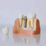 Cât costă un implant dentar dacă ai nevoie și de adiție osoasă sau sinus lift?
