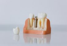 Cât costă un implant dentar dacă ai nevoie și de adiție osoasă sau sinus lift?