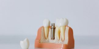 Cât costă un implant dentar dacă ai nevoie și de adiție osoasă sau sinus lift?
