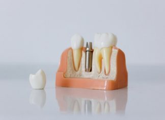 Cât costă un implant dentar dacă ai nevoie și de adiție osoasă sau sinus lift?